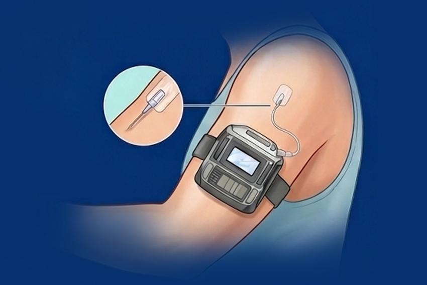 Parkinson Tedavisinde İleri Yöntemler