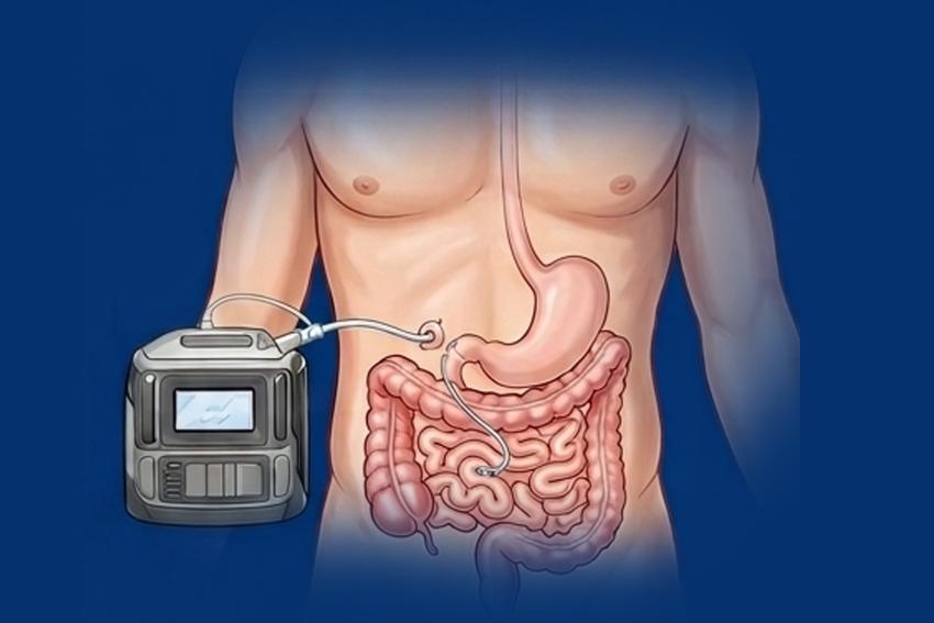 Parkinson Tedavisinde İleri Yöntemler
